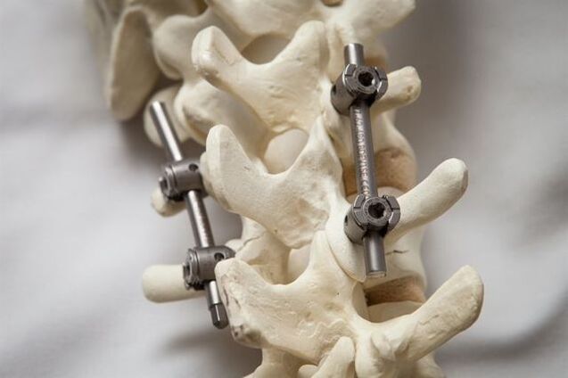 fixation of spinal osteochondrosis in the neck