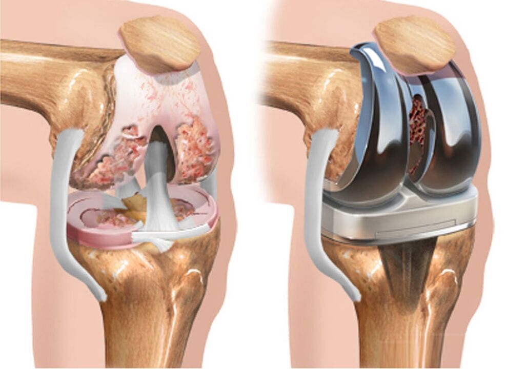 before and after knee joint arthrosis for arthrosis
