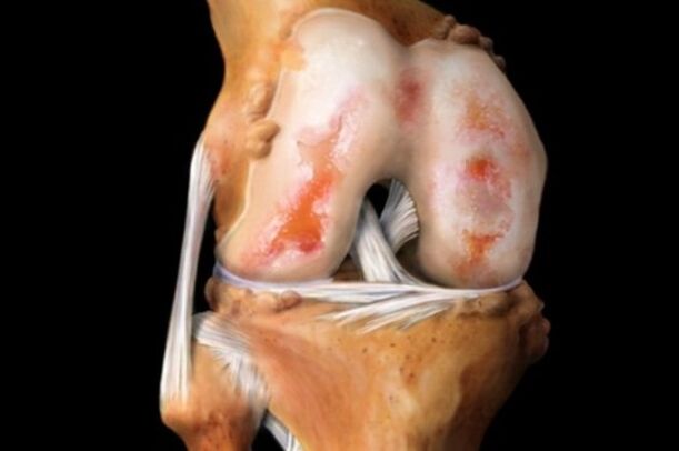 cartilage damage in knee arthrosis