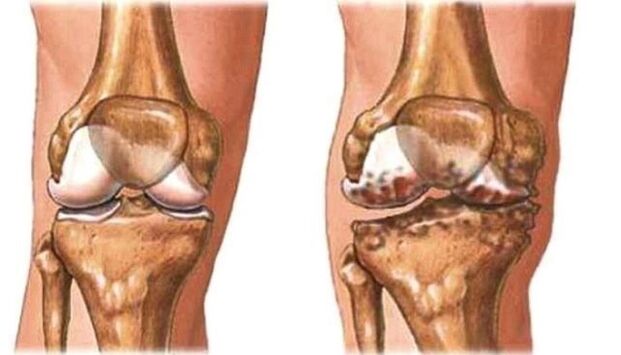 knee arthrosis and healthy knees