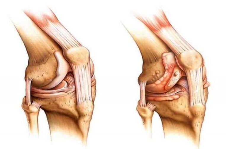 healthy knees and knee joint arthrosis