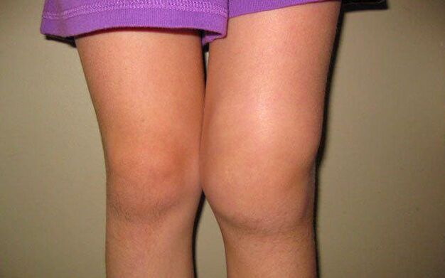 swollen knee joints due to osteoarthritis