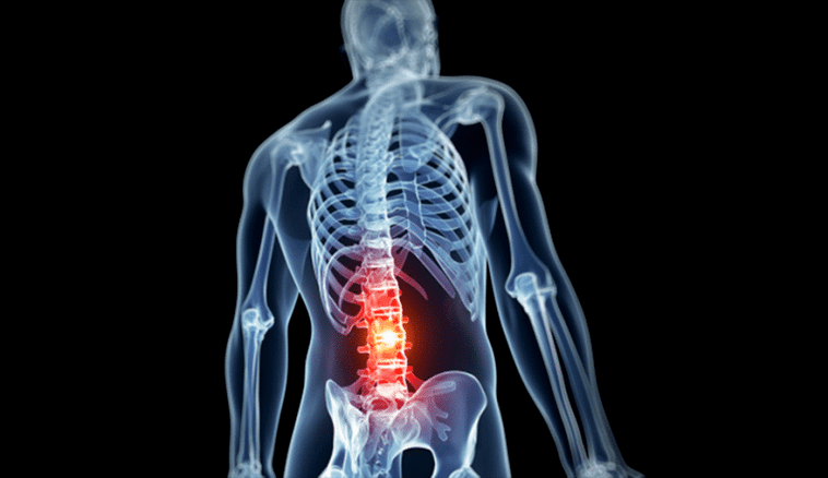 Lumbar spine lesions in osteochondrosis