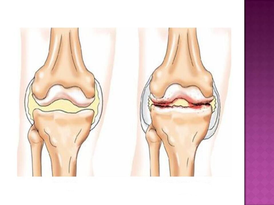 Joints are normal (left) and affected by osteoarthritis (right)