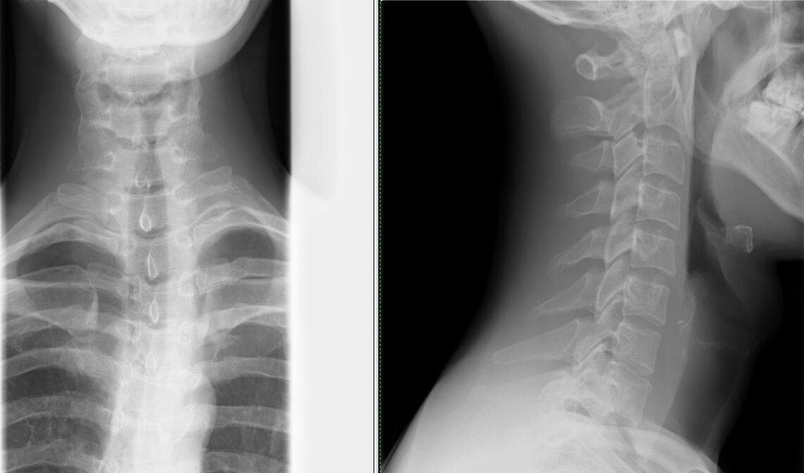 X-ray of the spine is a simple and effective method for diagnosing osteochondrosis