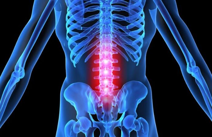 Osteochondrosis of the lumbar area