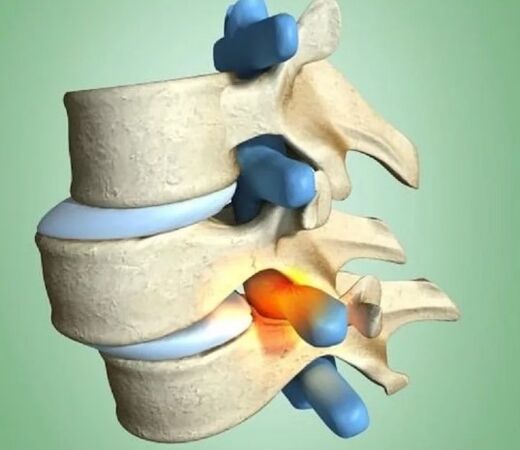 Unstable vertebral position