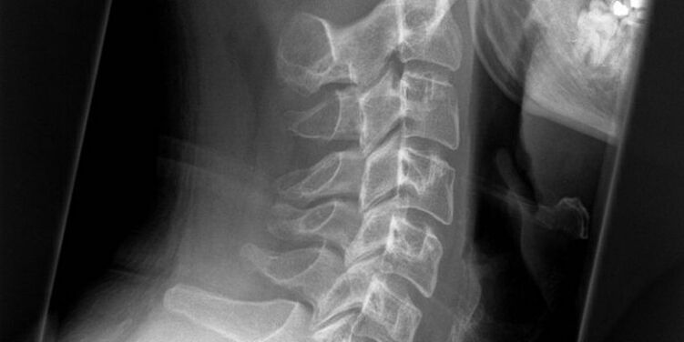 A picture of a cervical area
