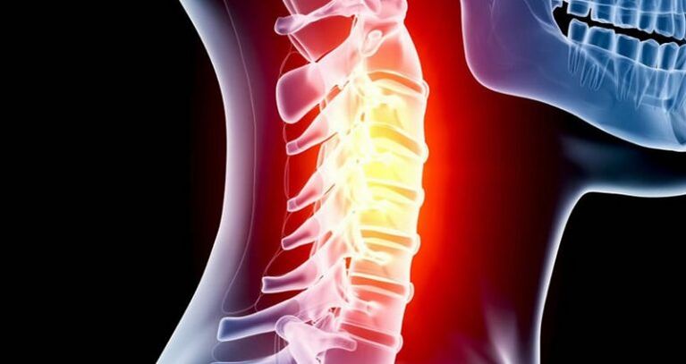 Inflammation in the cervical area