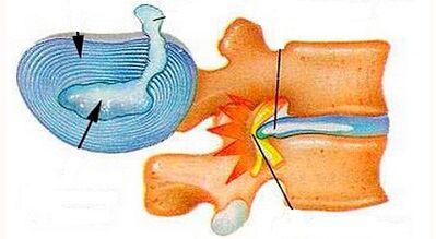 Characteristics -The development of cervical osteochondrosis