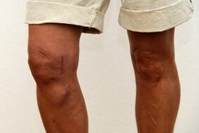 knee joint swelling due to arthrosis